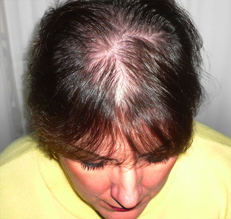 Loss wellbutrin hair from